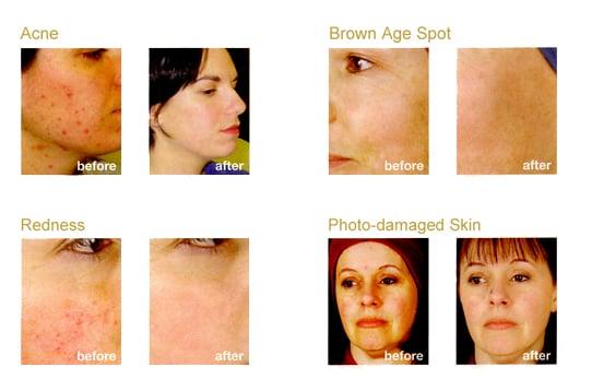 PCA Medical Grade Facial Peels (Seasonal)