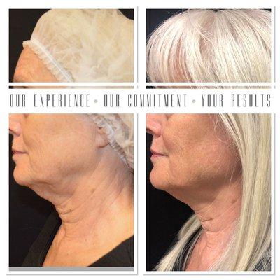 Actual client 8 months post 1 Ultherapy and 1 Fractional Treatment.