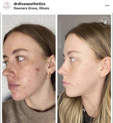 ACNE TREATMENTS BEFORE AND AFTER