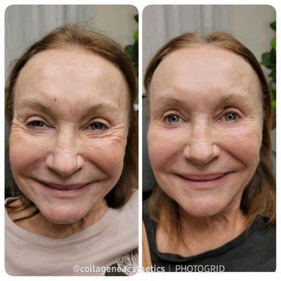 One of our beautiful client' results after some Botox and fillers for overall facial rejuvenation.