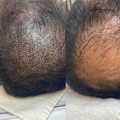 Scalp micro-pigmentations