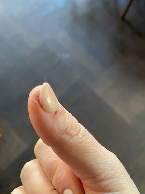 Bleeding cuticle