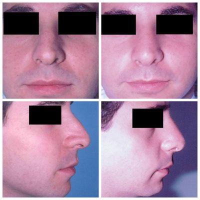 35-44 year old man treated with Rhinoplasty