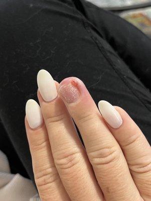 5 days after getting the nail off, still so painful.