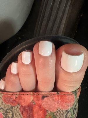 Slanted toenail cut