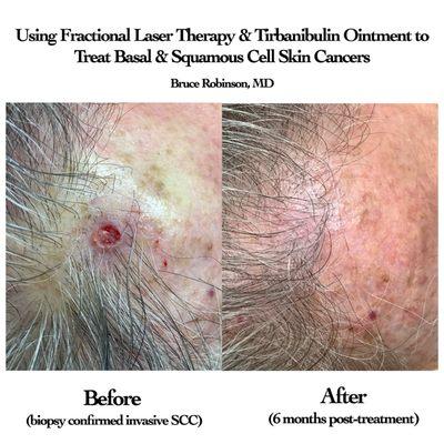 The use of fractional lasers to wipe out BCCs or SCCs promises to open a whole new chapter in skin cancer treatment, and Dr...