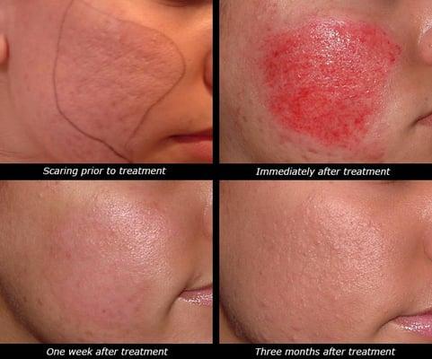 Collagen Induction Therapy (Skin Needling) for acne scarring, wrinkles, large pores, smooth skin.