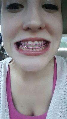 (AFTER)This is after multiple fillings-I was able to have braces after MONTHS of hard work.