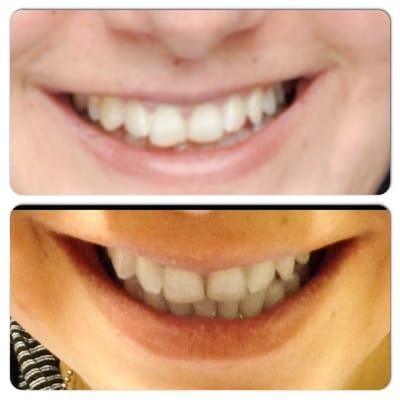 Teeth Contouring (two front teeth) by Glow Dental. VERY happy with my results. Changed my smile!!!