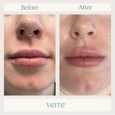 Our client's before and after 1/2 Volbella syringe.