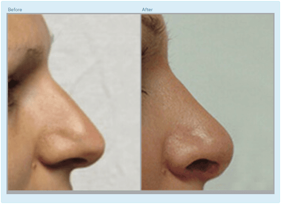 Rhinoplasty: Before and After