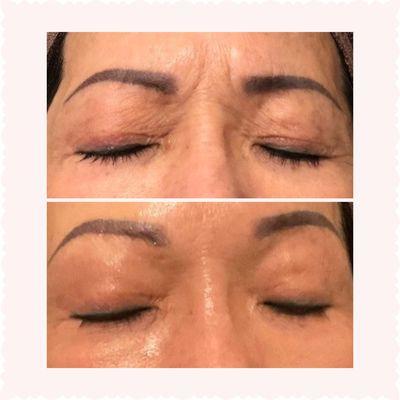 Eye wrinkle treatment