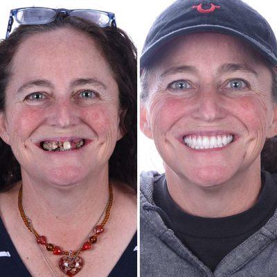 Final results from full mouth dental implants