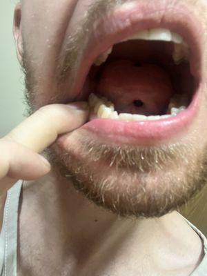 This is a picture of the side of my tooth with root that is exposed insure that I will need another crown.