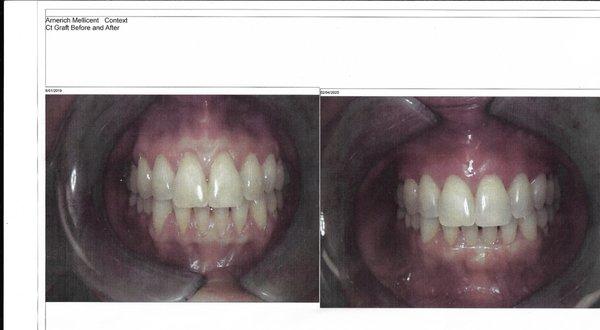 before and after gum graft