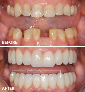 Before and After at NÜVA Smile | Clifton, NJ