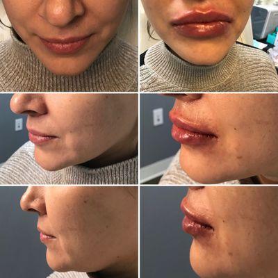 Gorgeous full lips immediately post-injection using 1 syringe of Restylane @alea_medspa .