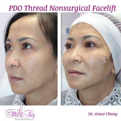 PDO Threads Nonsurgical Facelift