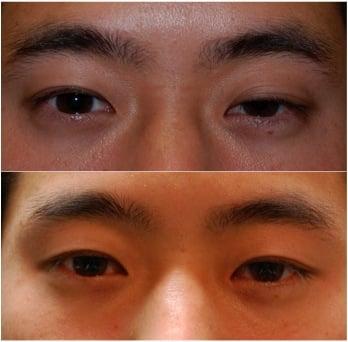 left upper eyelid ptosis repair