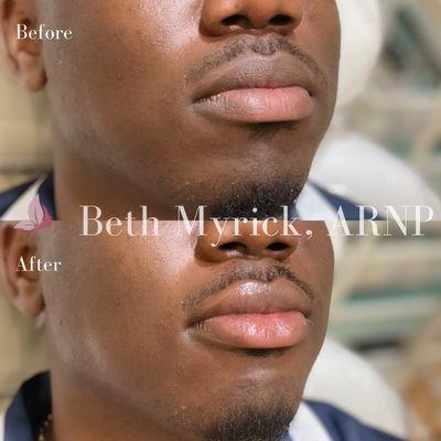 Male Lip Filler