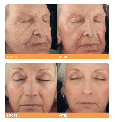 Before and After:  Smart Skin CO2 Ablative Laser