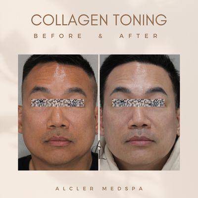 Collagen Laser Toning