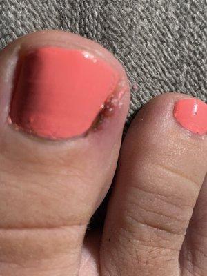 Infected toe