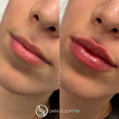 Amazing lip filler results with Dr. D at Omni Sculpt MD Med spa in dallas Texas