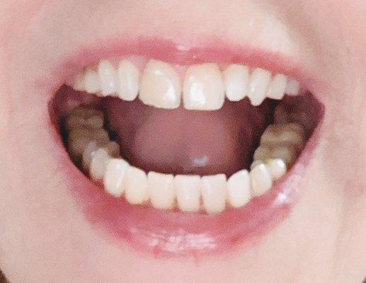 My 67 yr old teeth. So delighted!