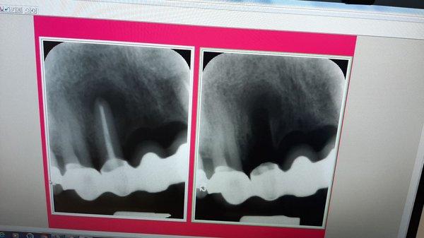 My surgery for root amputation was successful.......