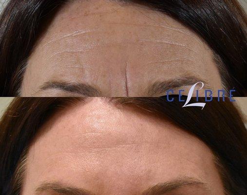 Botox and Dysport for frown lines and forehead. Restylane too.