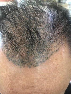 Pigment scalp tattoo by dr song truong staff