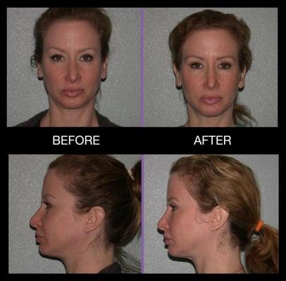 Upper/lower blepharoplasty 6 months post-op.