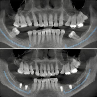 Surgery Implant before and after