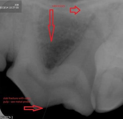 We have dental xray to assess the +50% of the tooth not visible