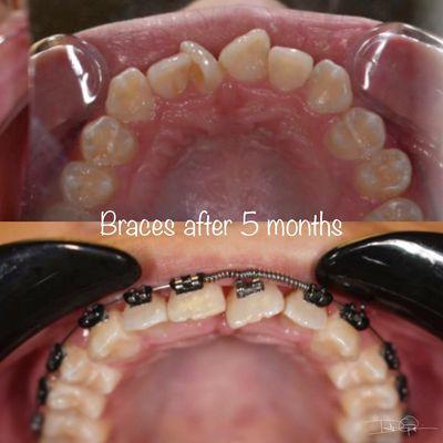 Braces after 5 months.