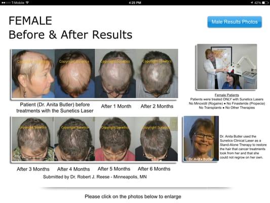 FDA Approved Laser Hair restoration, Get March Specials, Act fast.