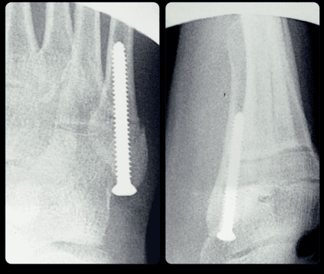 Repair of Jones fracture.