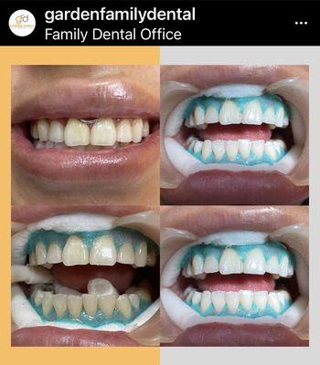 Teeth whitening for your bright smile!!!