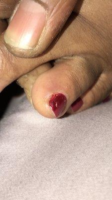 Infected hangnails after pedicure.