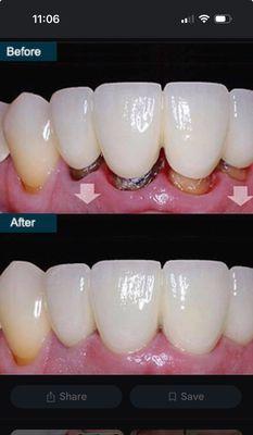 Replacement of old bridge with a new Zirconia bridge