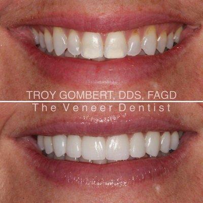 smile makeover with porcelain veneers.