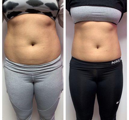 Progress photos of laser Lipo + Lipo Cavitation