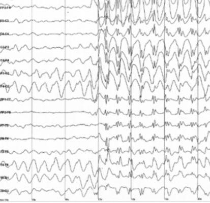 Sample of a EEG Study