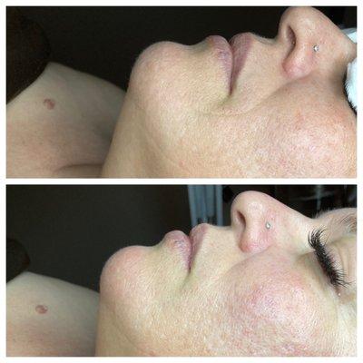 After just one session of using our FIRMING TREATMENT MASK, the line around her lips has disappeared!!