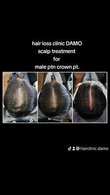 Male pattern, Crown area.
DAMO non surgical scalp treatment.