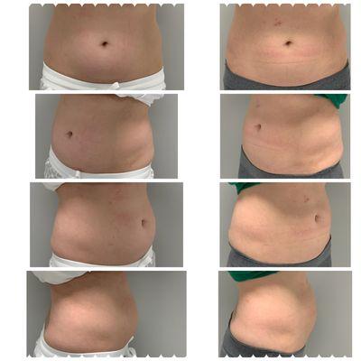 Before and after 1 session SculpSure body contouring