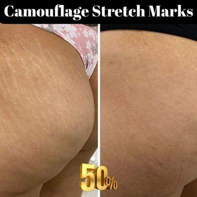 Camouflage Stretch Marks