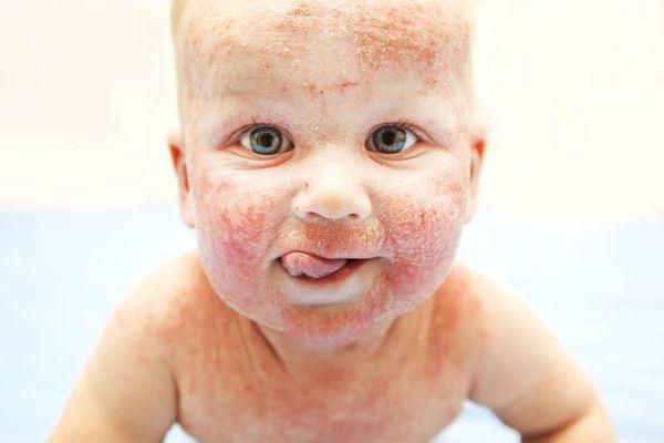 Studies have linked eczema with hard water and chlorine.