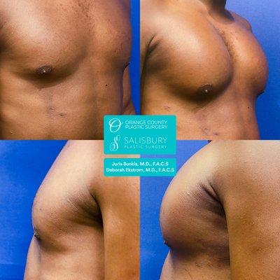 Pec implants by Dr. Bunkis